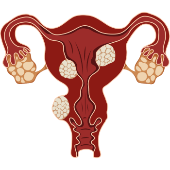 uterine fibroids